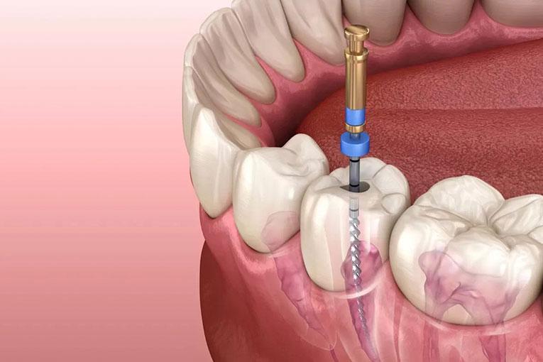 endodoncia.001