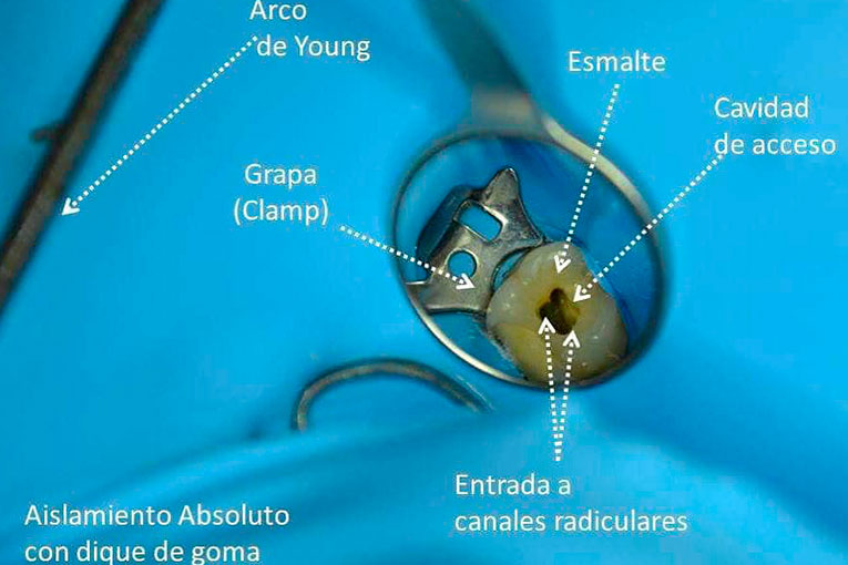 endodoncia.002