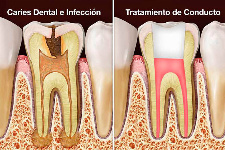 endodoncia.006