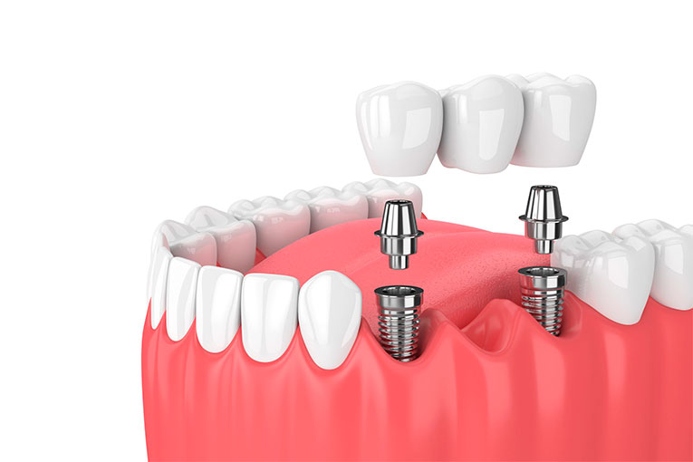 implante-dental02