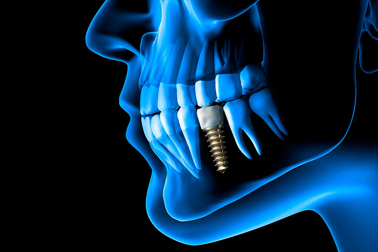 implante-dental03b