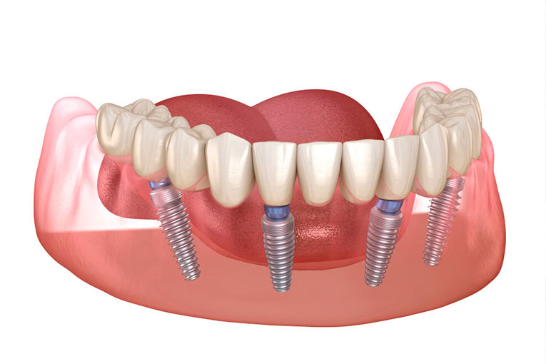 implantes-dentales.001