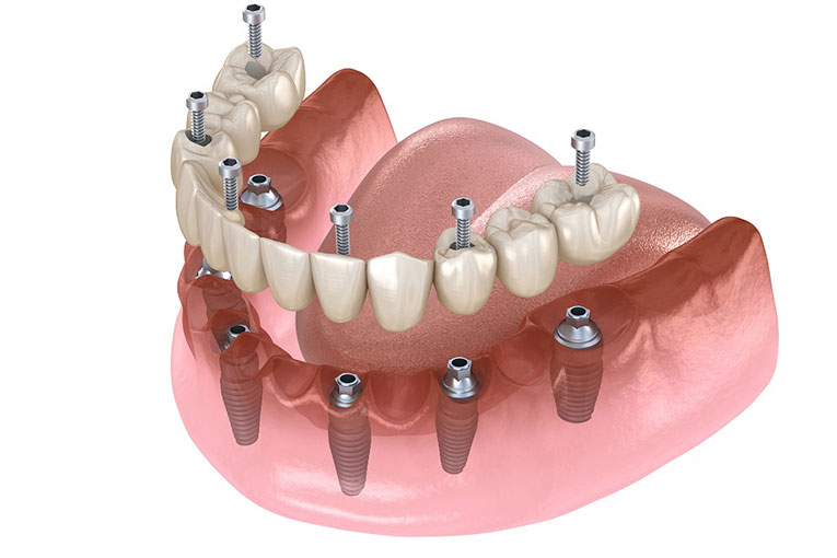 implantes-dentales.002