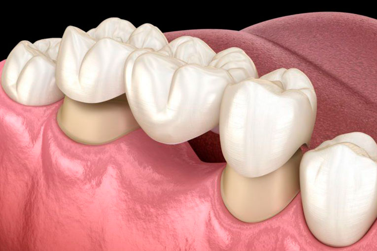 implantes-dentales.003