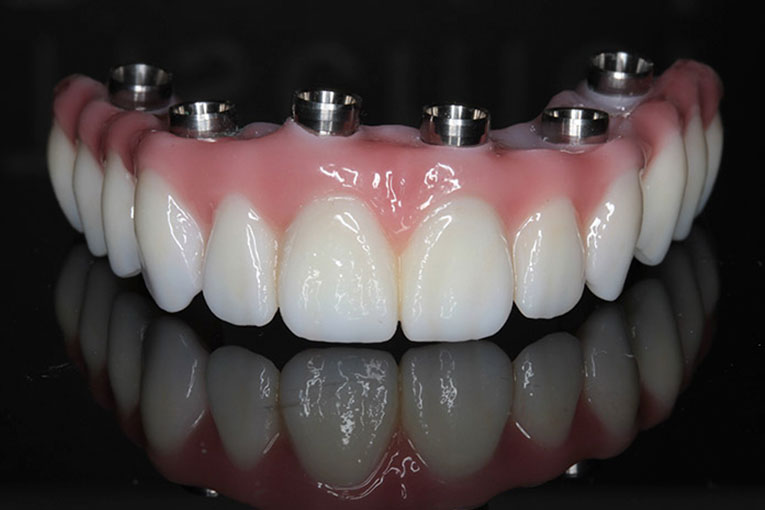 implantes-dentales.004