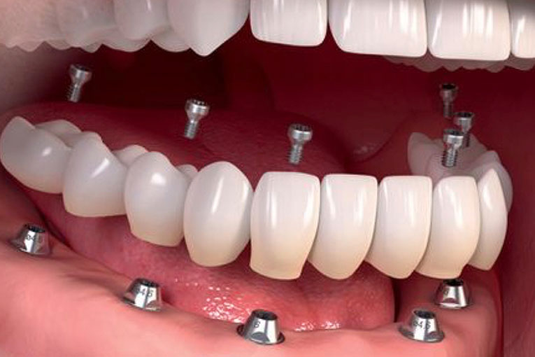 implantes-dentales.005