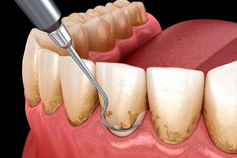 limpieza-dental.001